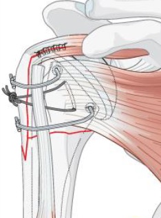 humerus arthroplasty picture