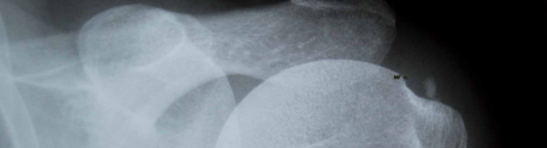 shoulder xray with calcific tendonitis