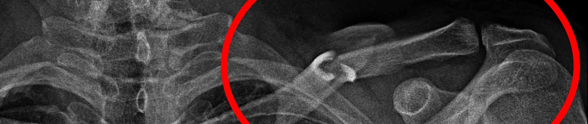 x-ray with clavicle fracture