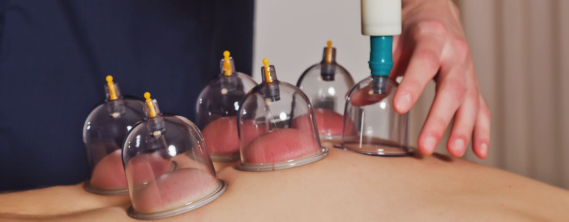 cupping therapy