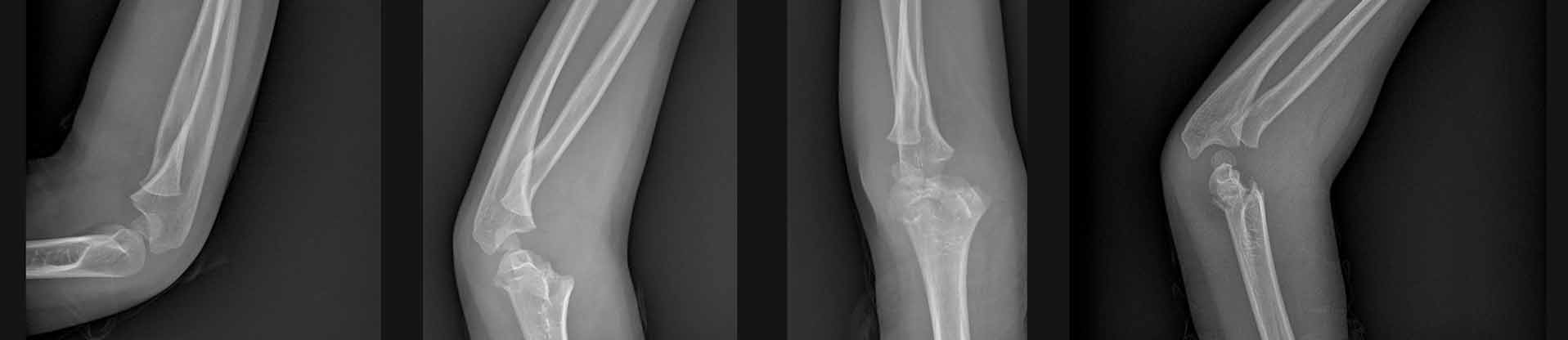 x-rays with elbow fractures