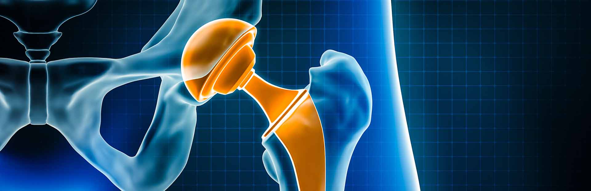 graphic depicting hip arthroplsty