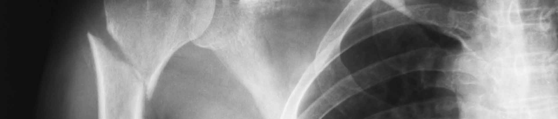 x-ray with humerus fracture