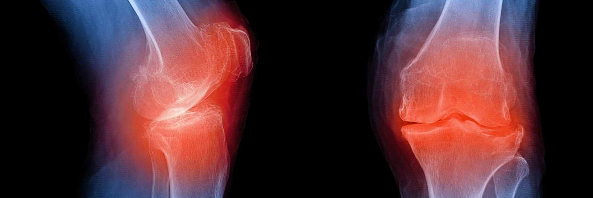 x-ray of knee with osteoarthrits